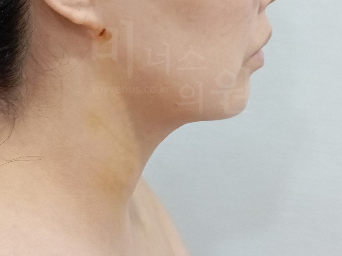 이중턱 지방흡입 수술 후 측면② (2024년 촬영)