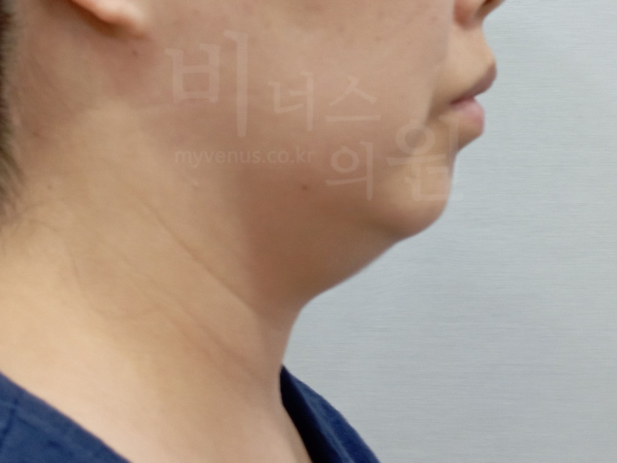이중턱 지방흡입 수술 전 측면② (2024년 촬영)