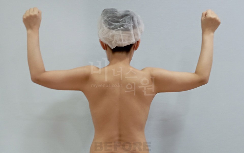 팔뚝 지방흡입 사례 후면 팔을 위로 든 자세 수술 전