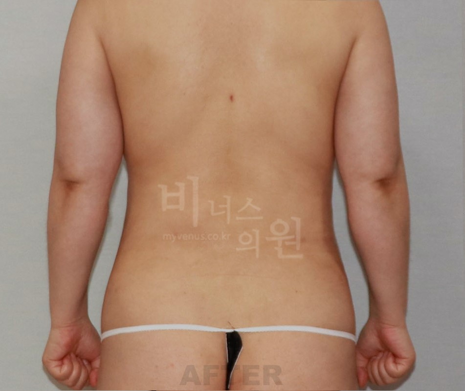 복부 지방흡입 수술 후 후면 사례 사진