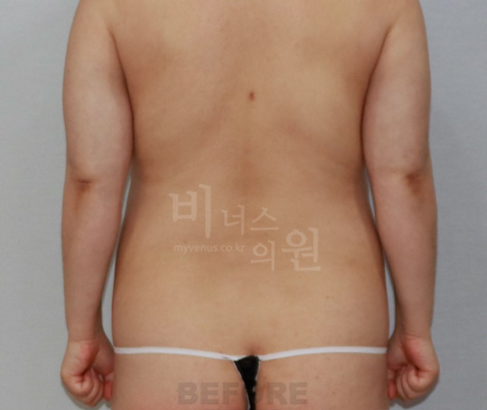 복부 지방흡입 수술 전 후면 사례 사진