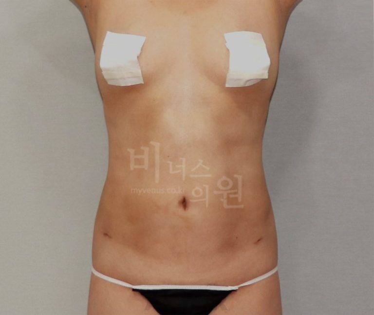 복부 지방흡입 수술 후 정면 사례 사진