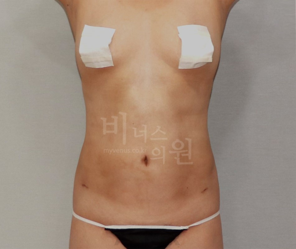 복부 지방흡입 수술 후 정면 사례 사진