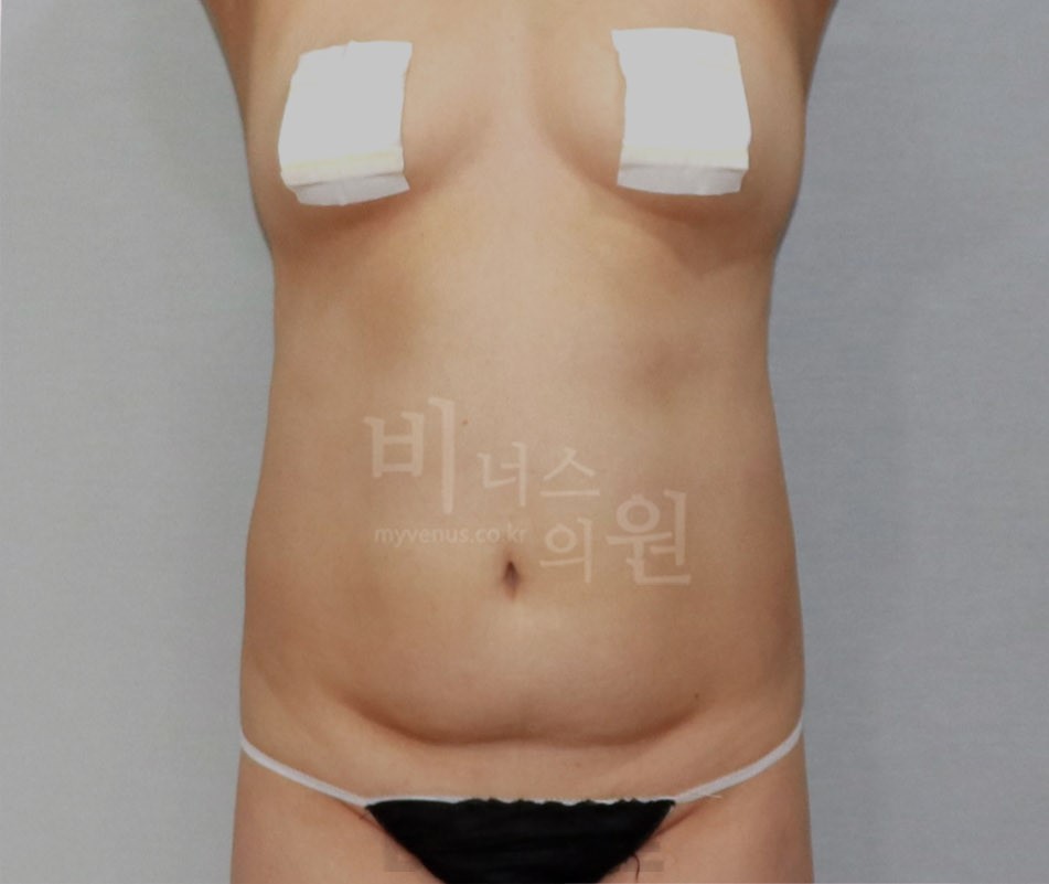 복부 지방흡입 수술 전 정면 사례 사진