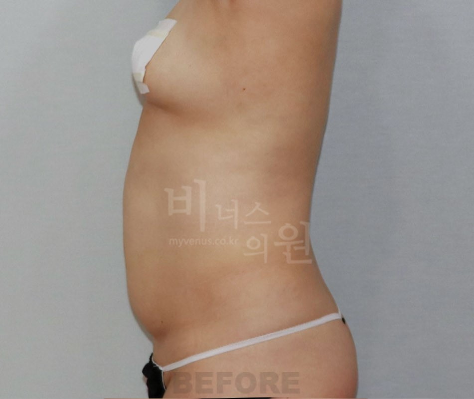복부 지방흡입 수술 전 측면 사례 사진