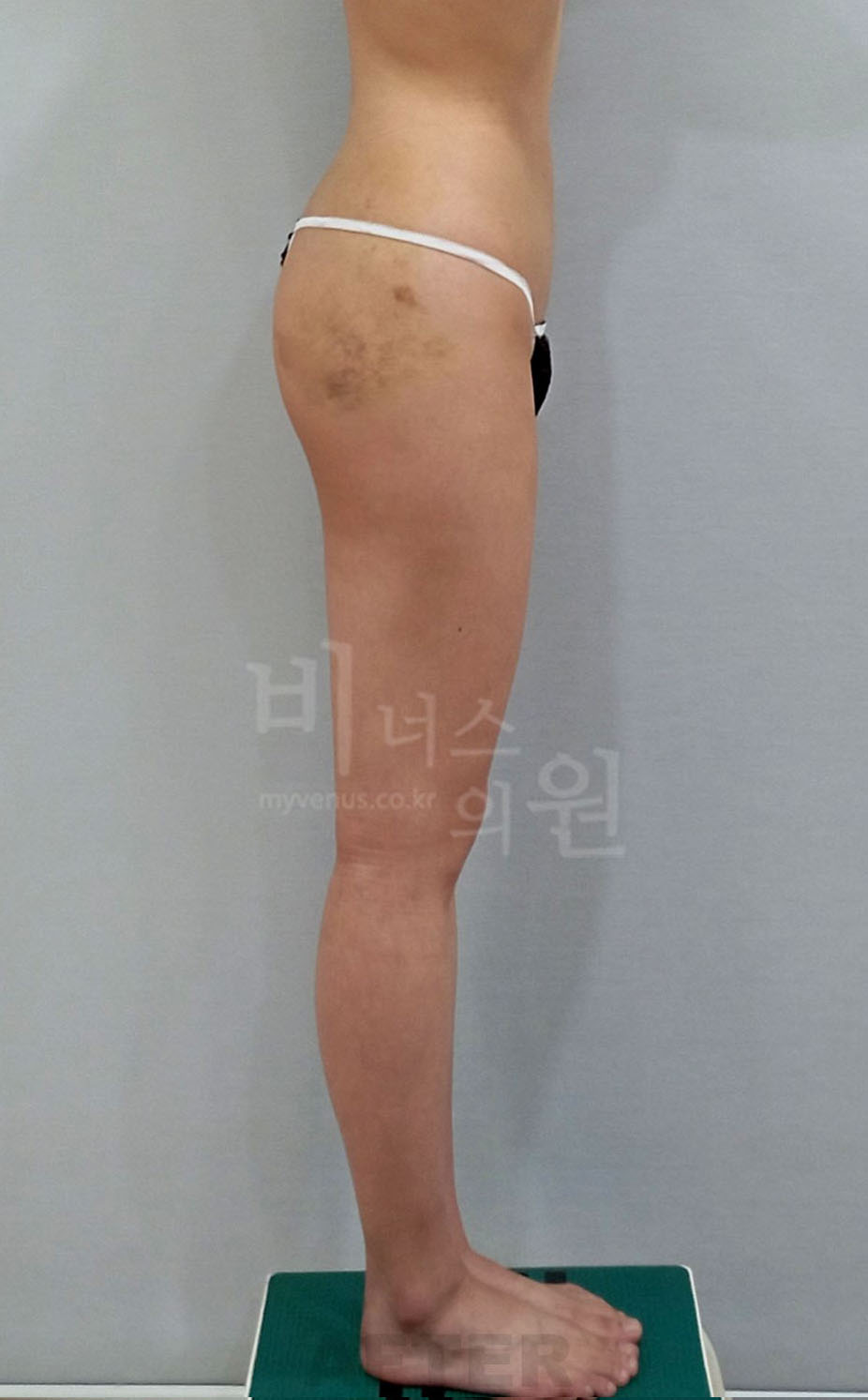 허벅지 안쪽과 엉덩이 라인 사례 사진 10 - 반대쪽 측면 - 비너스의원 2023년 촬영 사례