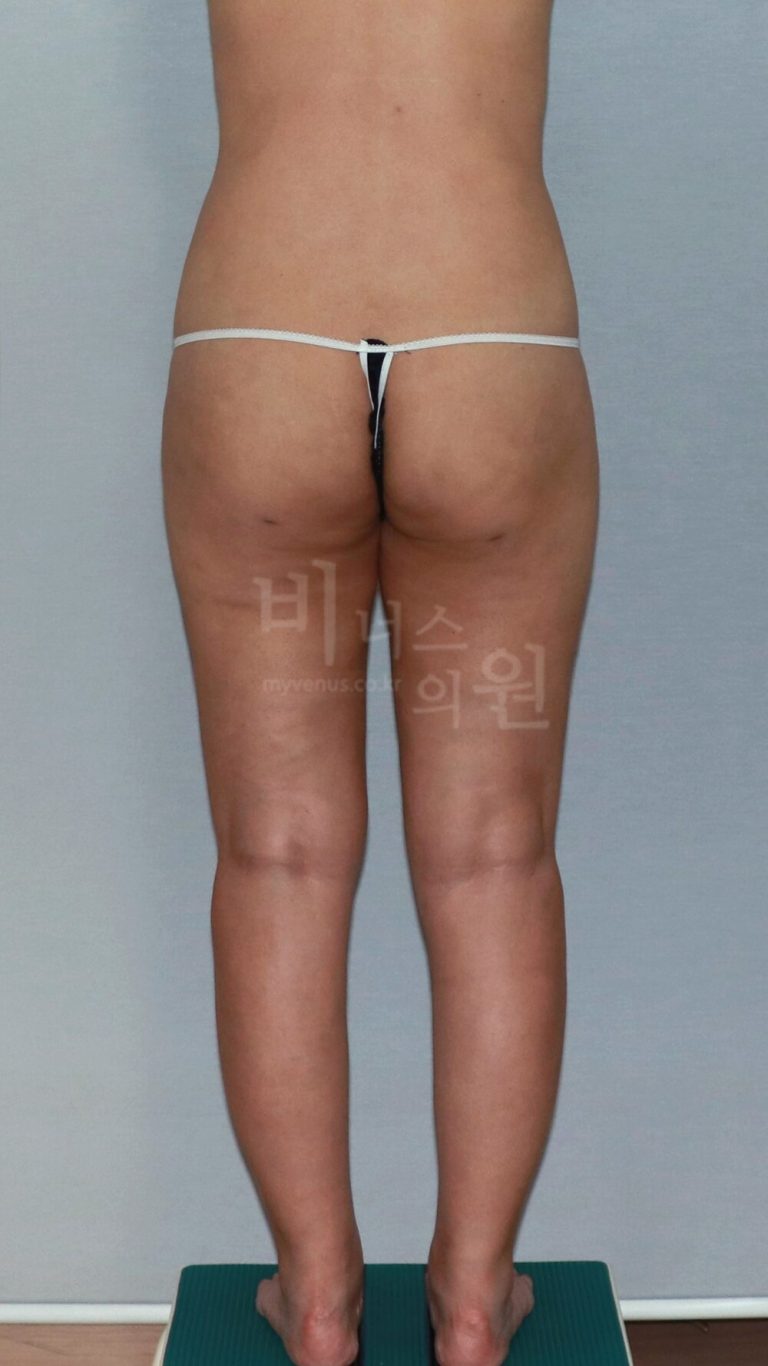 엉덩이축소 지방흡입 후 ‘서 있는 습관’ 점검 노트 — 엉덩이를 앞으로 밀어 넣는 자세, 일어설 때의 어지럼, 오래 선 날 저녁의 붓기까지