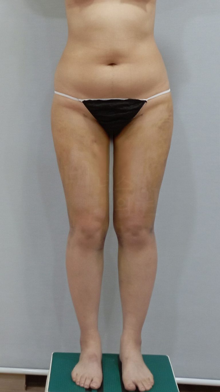 허벅지 지방흡입 일정, 날짜를 잡기 전에 달력부터 펼쳐 보세요 — 출근·운전·운동·큰 행사를 시점별로 짜 보는 복귀 달력