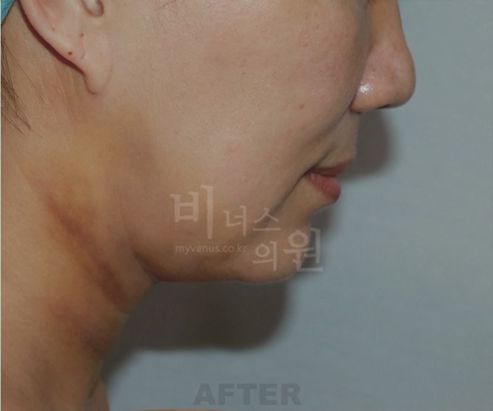턱·목 지방흡입과 지방이식 수술 후 옆모습 2 사진(얼굴 비식별 처리)