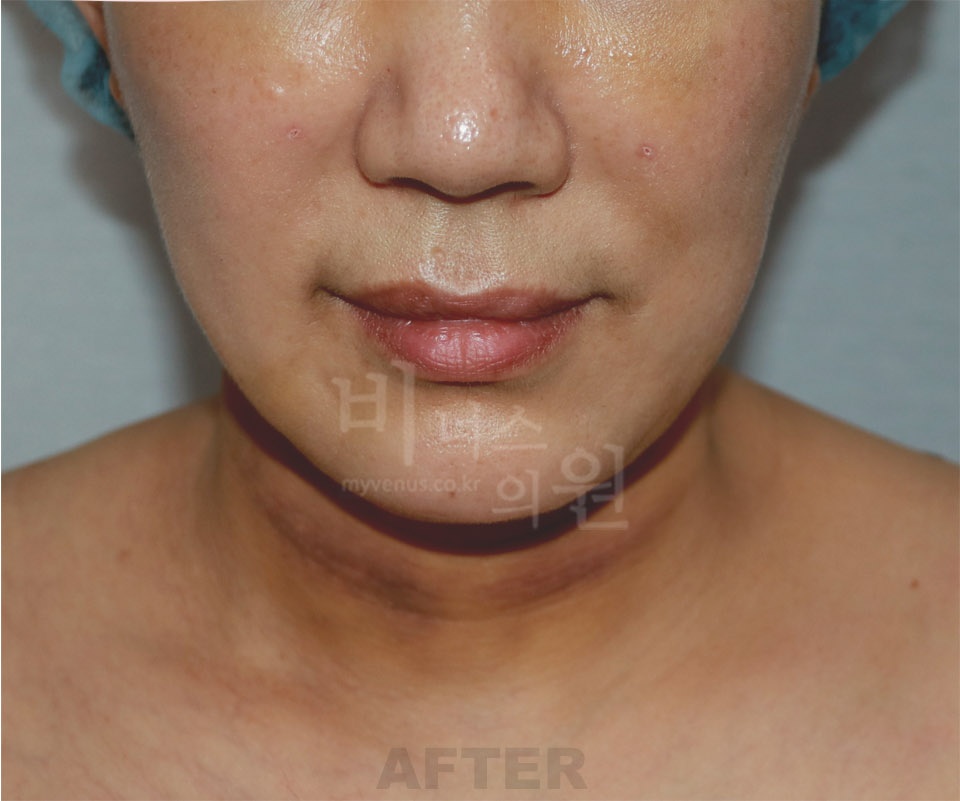 턱·목 지방흡입과 지방이식 수술 후 정면 사진(얼굴 비식별 처리)