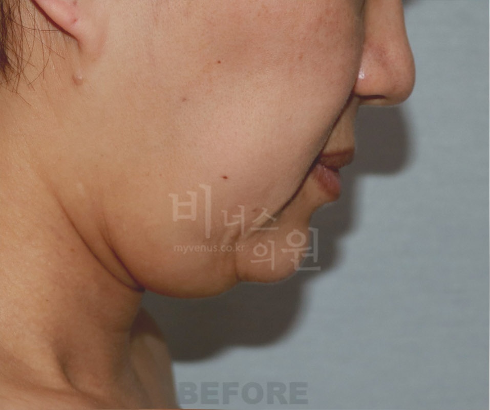 턱·목 지방흡입과 지방이식 수술 전 옆모습 2 사진(얼굴 비식별 처리)