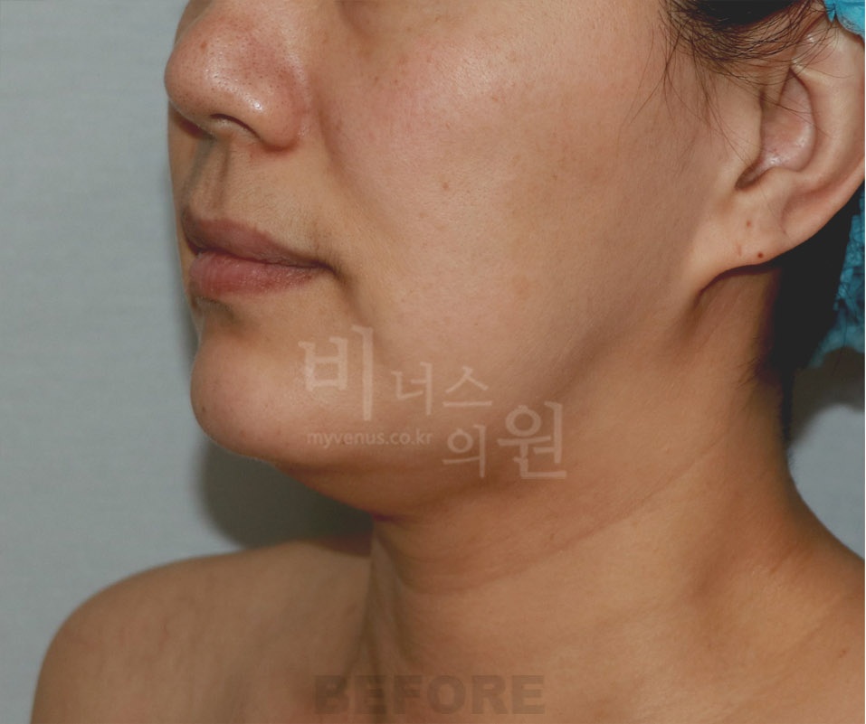 턱·목 지방흡입과 지방이식 수술 전 옆모습 1 사진(얼굴 비식별 처리)