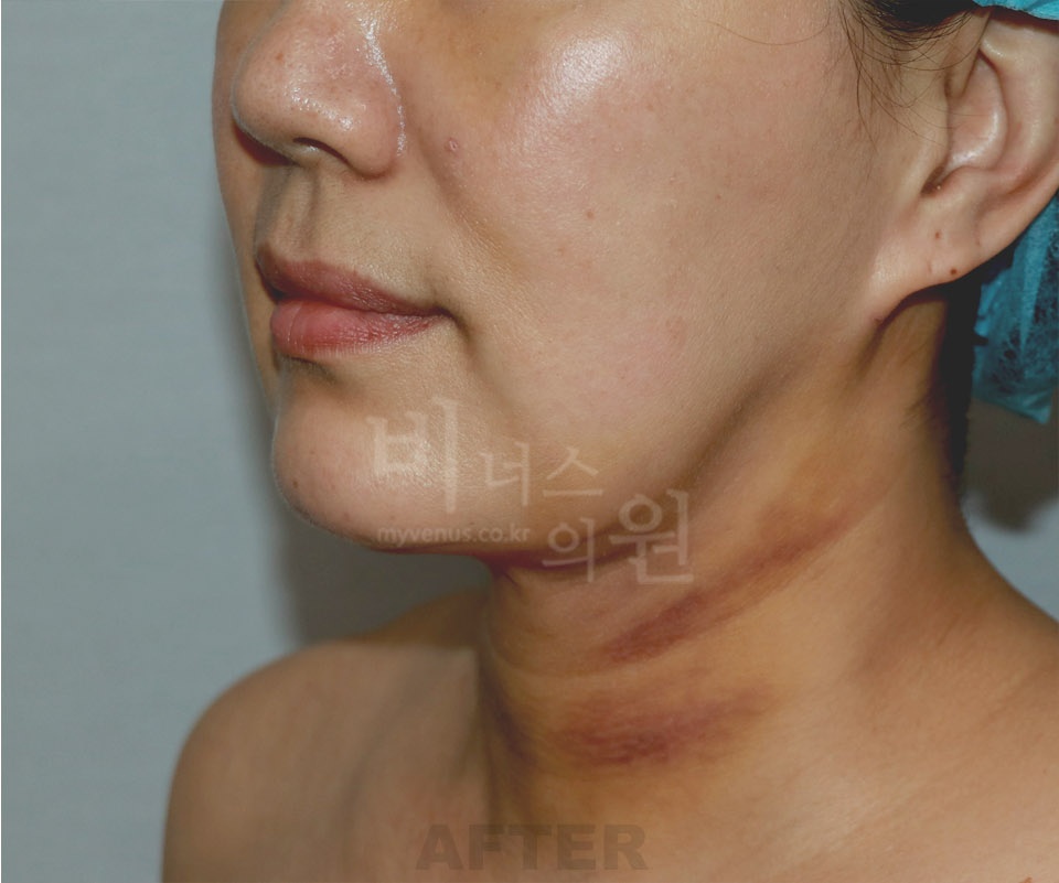 턱·목 지방흡입과 지방이식 수술 후 옆모습 1 사진(얼굴 비식별 처리)