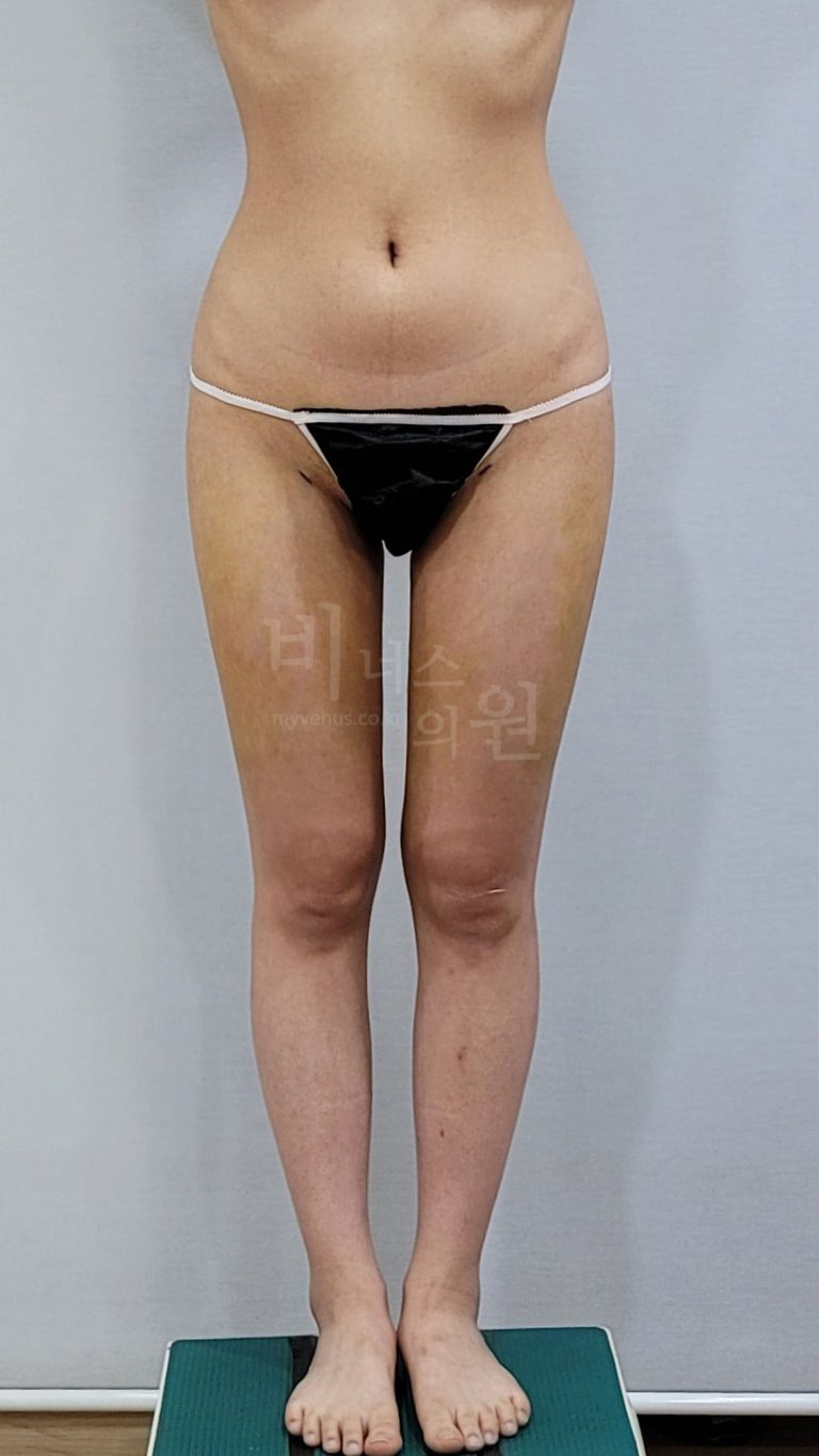 허벅지 지방흡입 회복기, 단단하고 울퉁불퉁해서 불안한 날에 — 경화과정을 알고 보내는 첫 한 달의 마음가짐