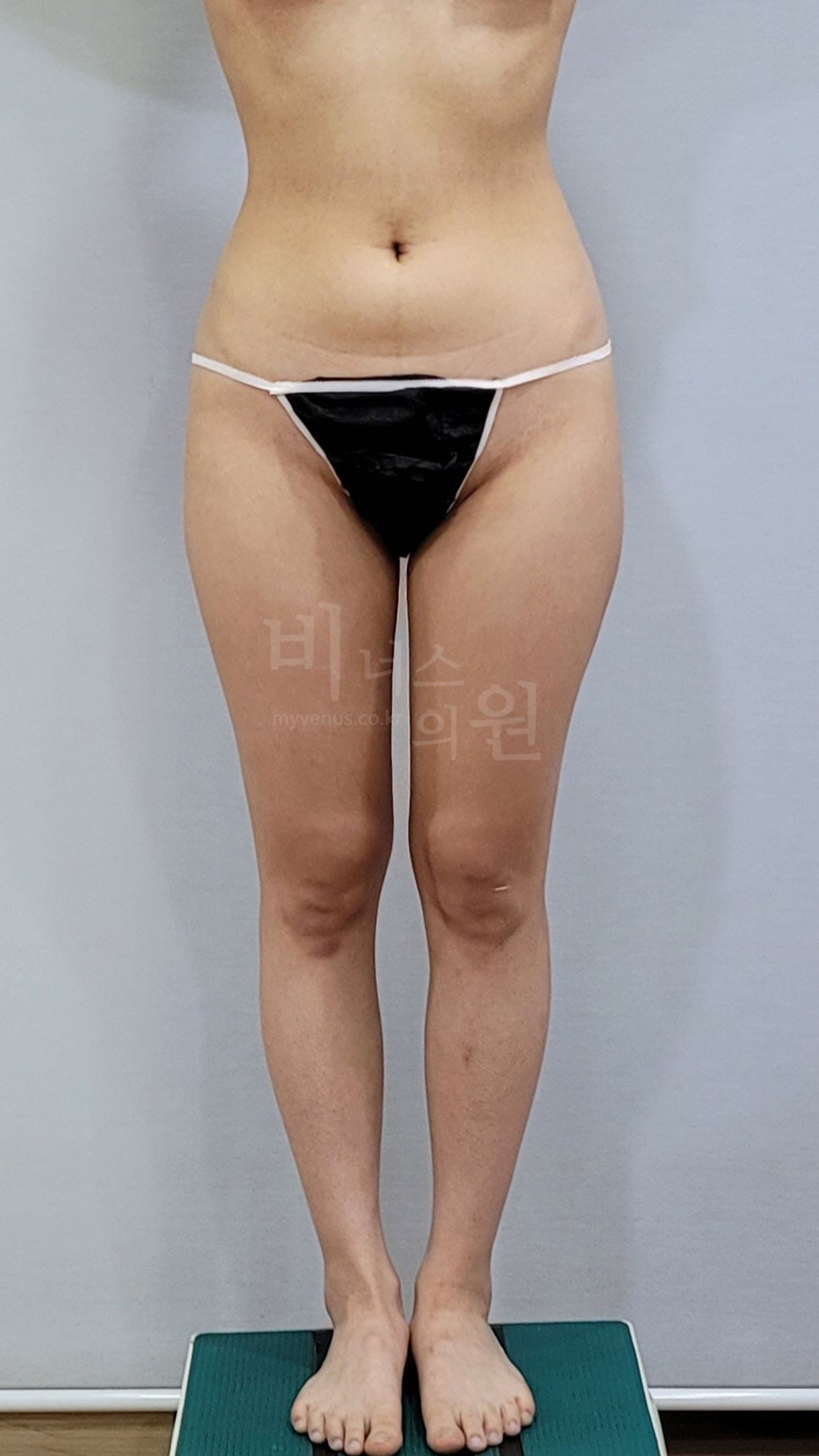 허벅지 지방흡입 수술 전 정면 ① — 두 다리를 모으고 선 자세