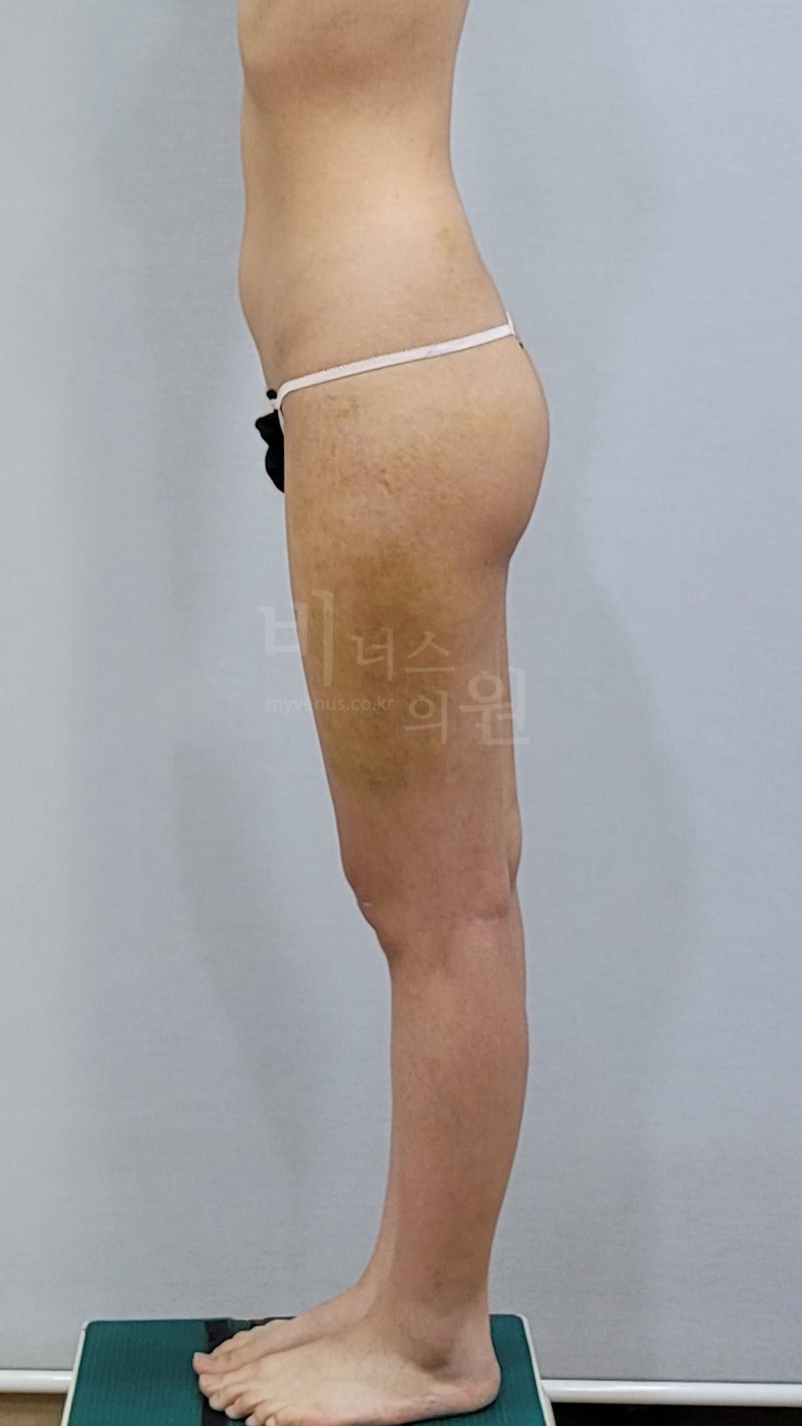 허벅지 지방흡입 수술 후 측면 — 같은 자세로 촬영