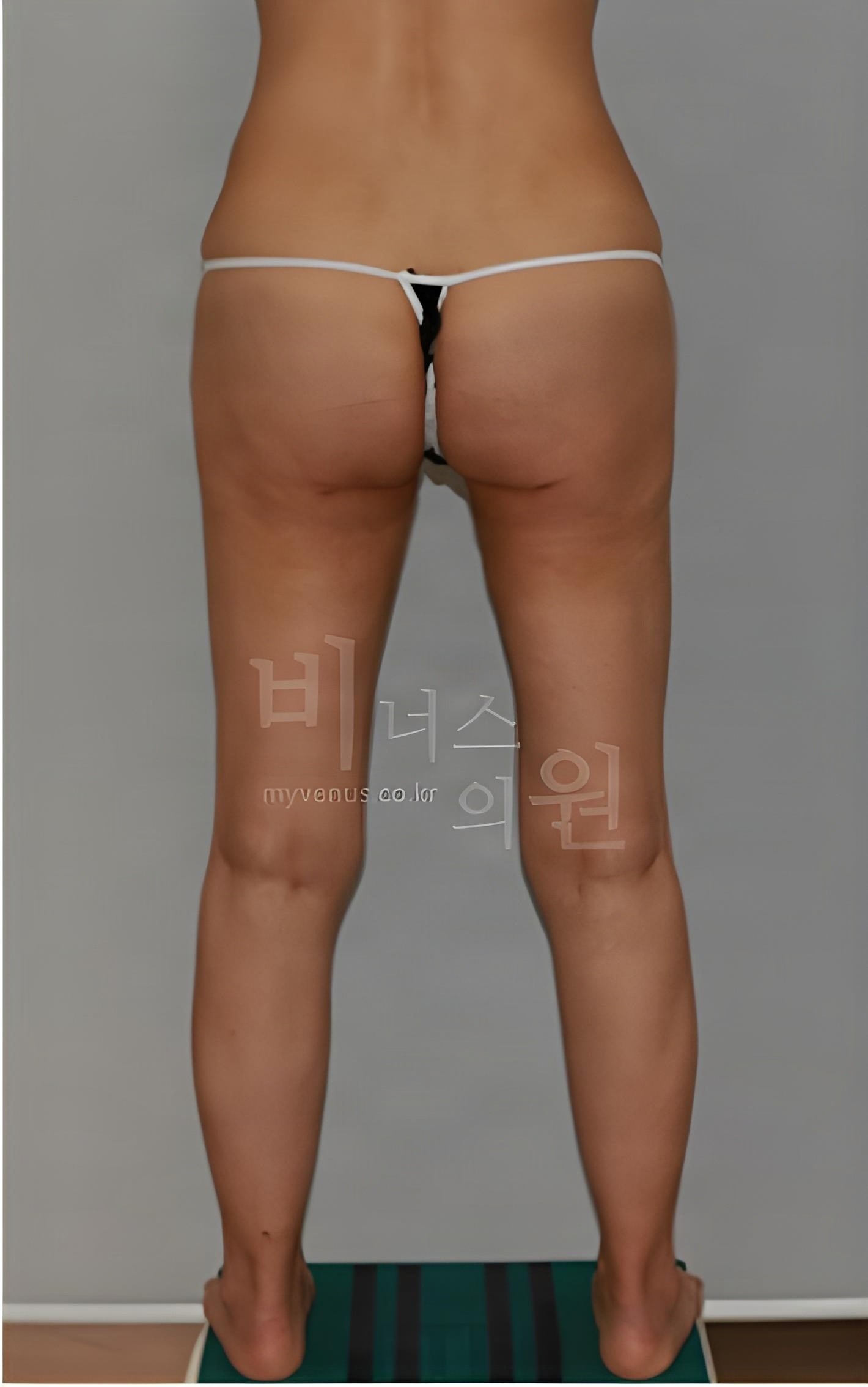 엉덩이축소 지방흡입 수술 후 후면 사선 각도 모습