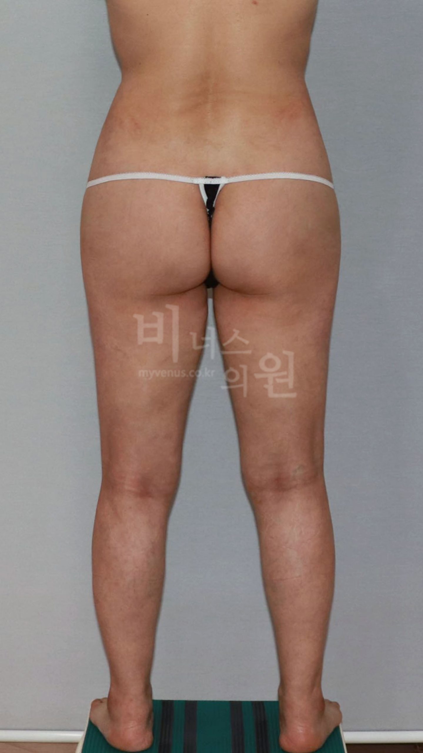 수술 후 후면 사진