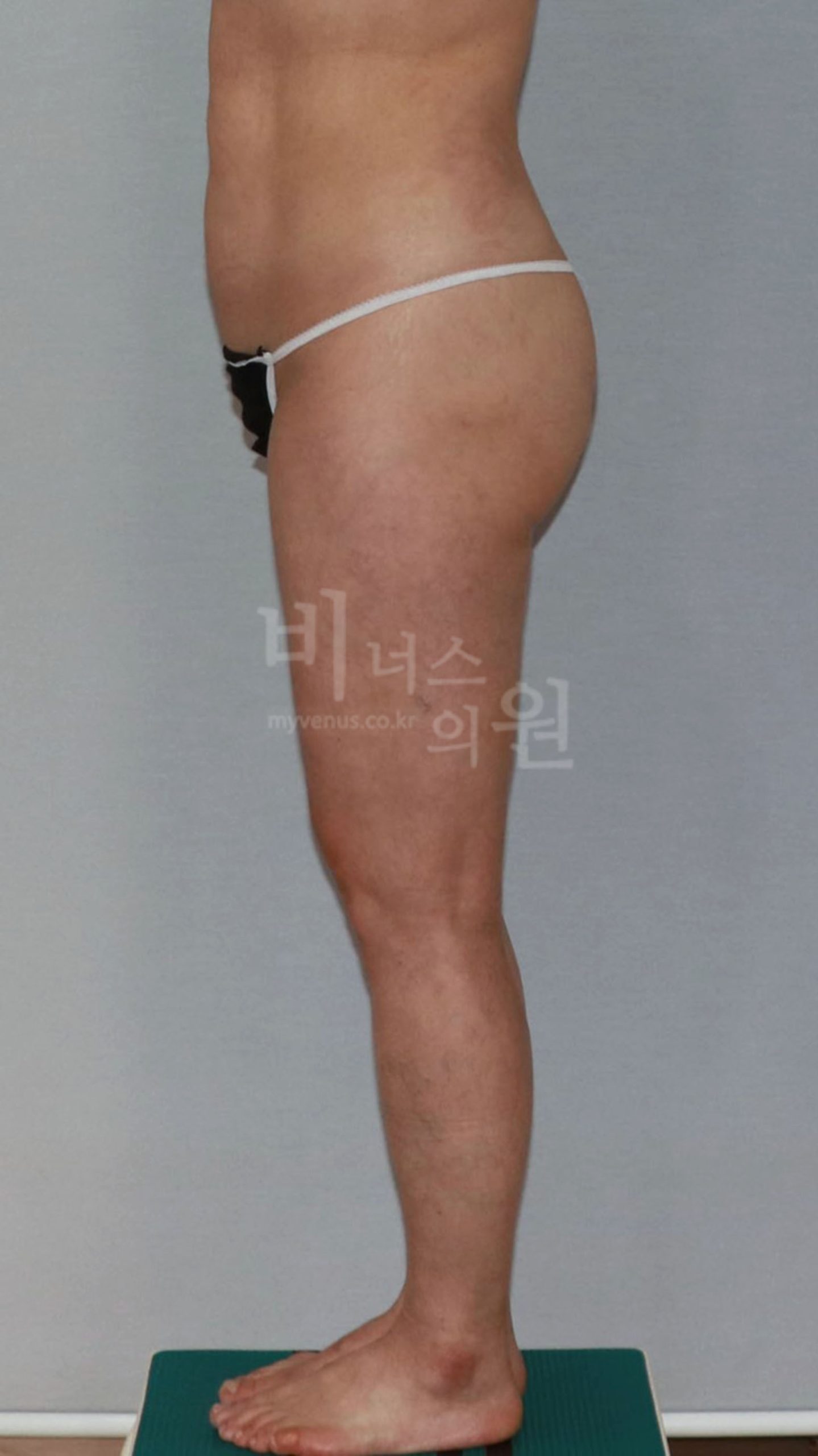 엉덩이축소 지방흡입 수술 후 측면 사진