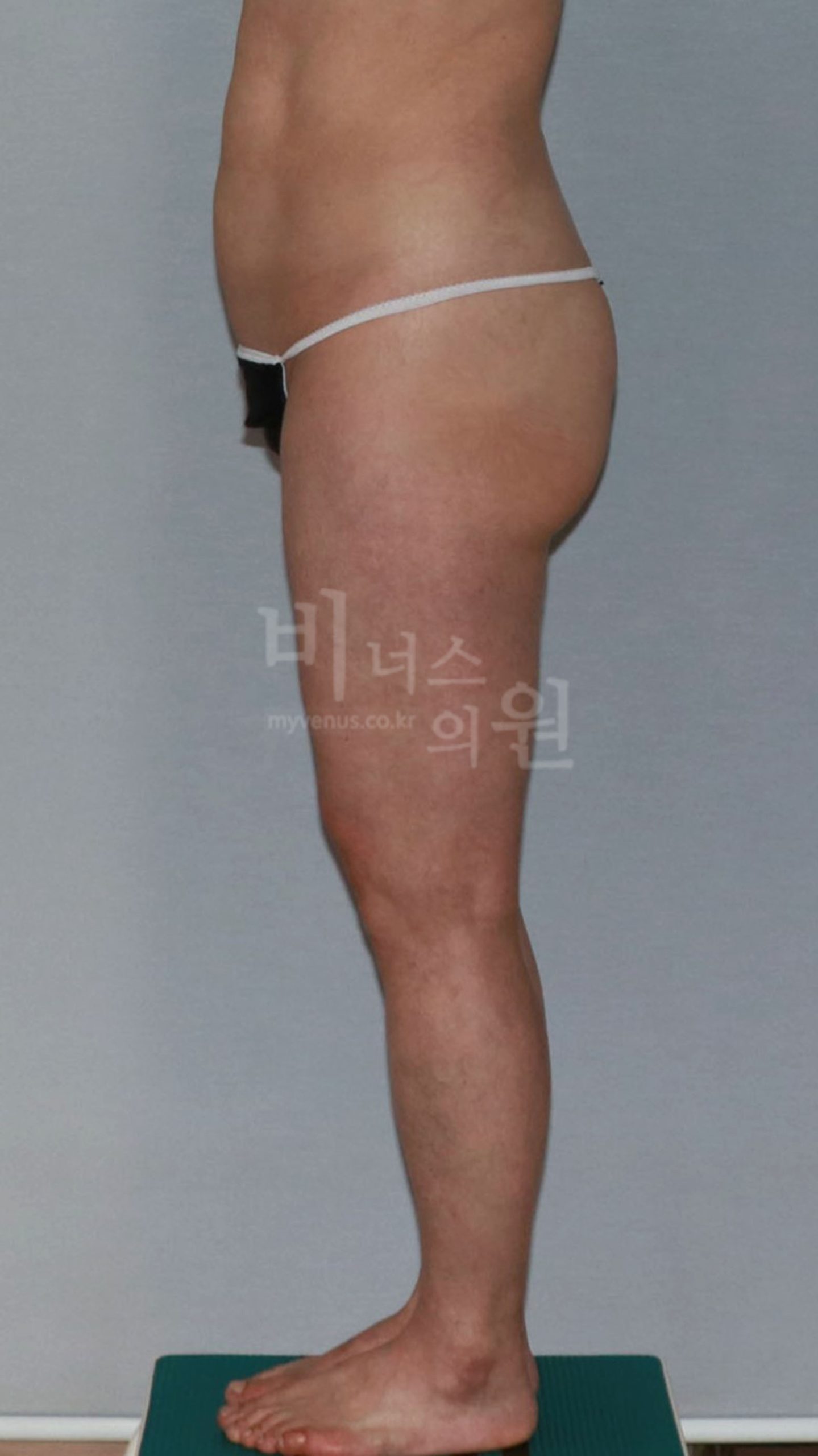 엉덩이축소 지방흡입 수술 전 측면 사진
