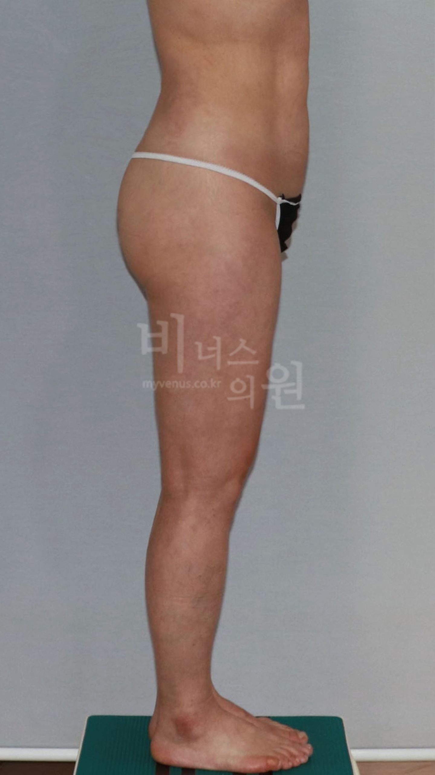 엉덩이축소 지방흡입 수술 후 반대쪽 측면 사진