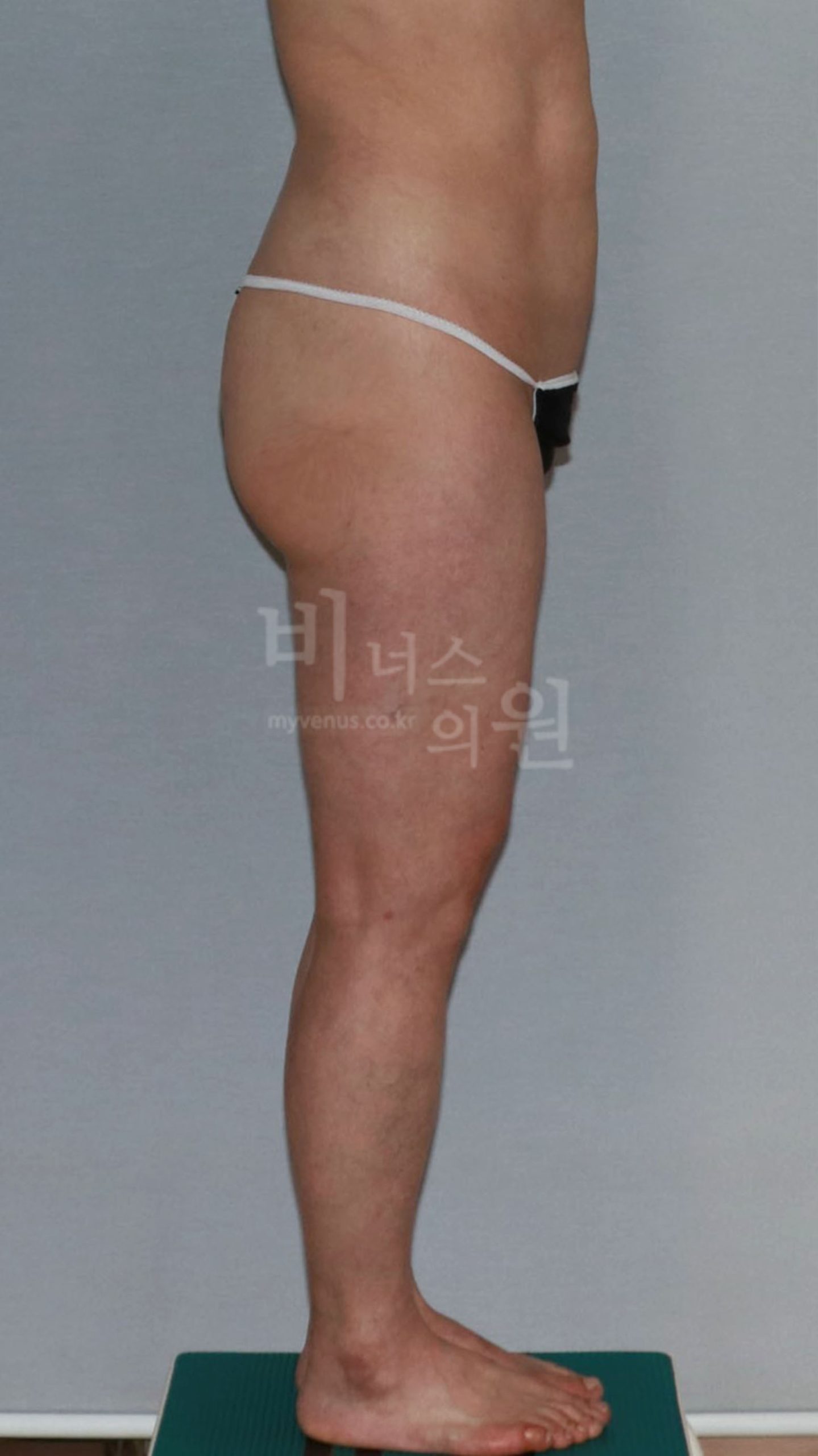 엉덩이축소 지방흡입 수술 전 반대쪽 측면 사진