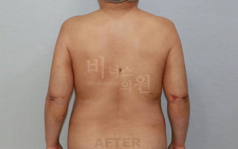 팔뚝 지방흡입 이후의 하루 — 팔을 올리고 내린 두 가지 자세로 읽는 수술 전후와 회복의 순서
