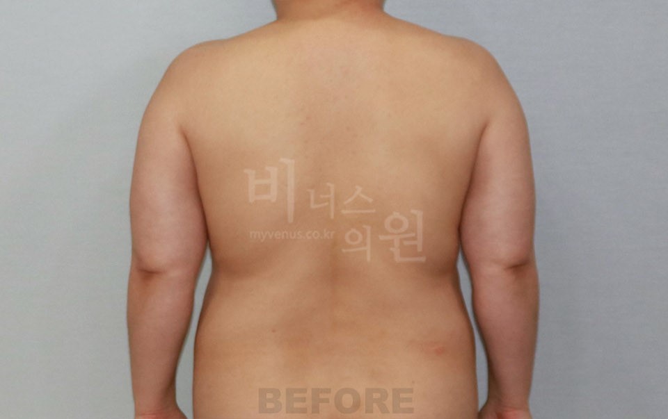 팔뚝 지방흡입 수술 전 후면, 양팔을 내린 자세