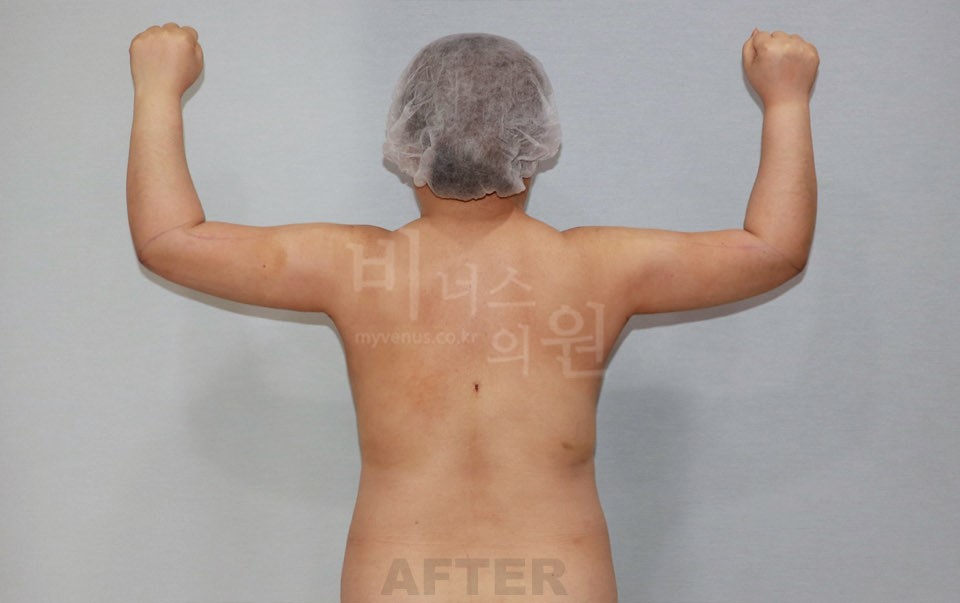 팔뚝 지방흡입 수술 후 후면, 양팔을 위로 올린 자세