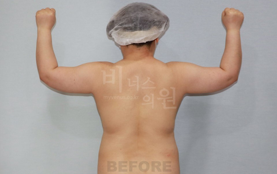 팔뚝 지방흡입 수술 전 후면, 양팔을 위로 올린 자세