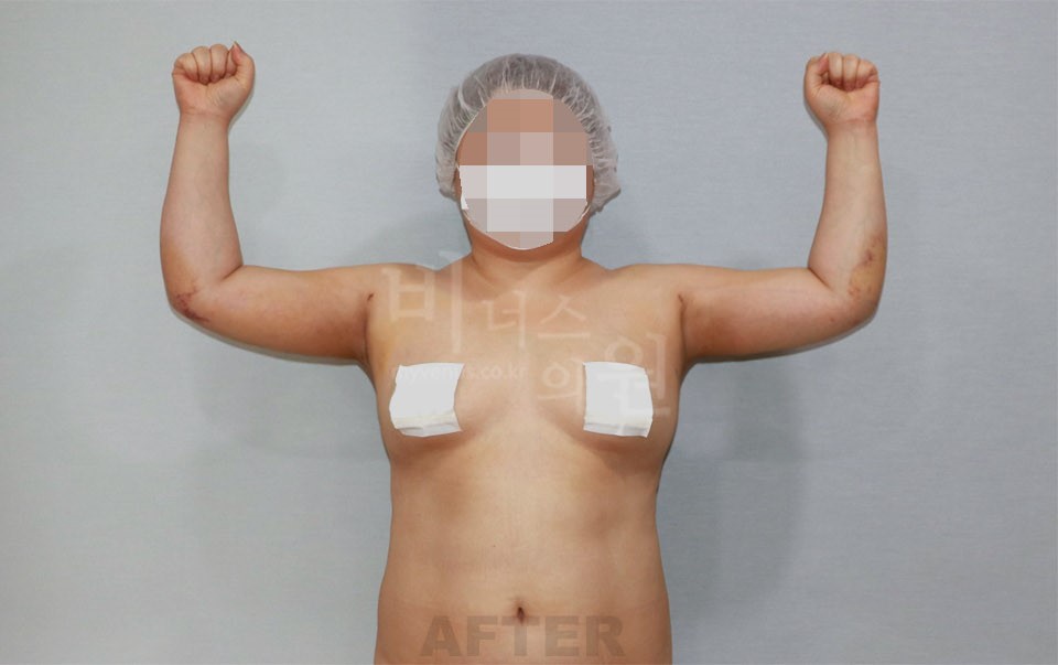 팔뚝 지방흡입 수술 후 정면, 양팔을 위로 올린 자세