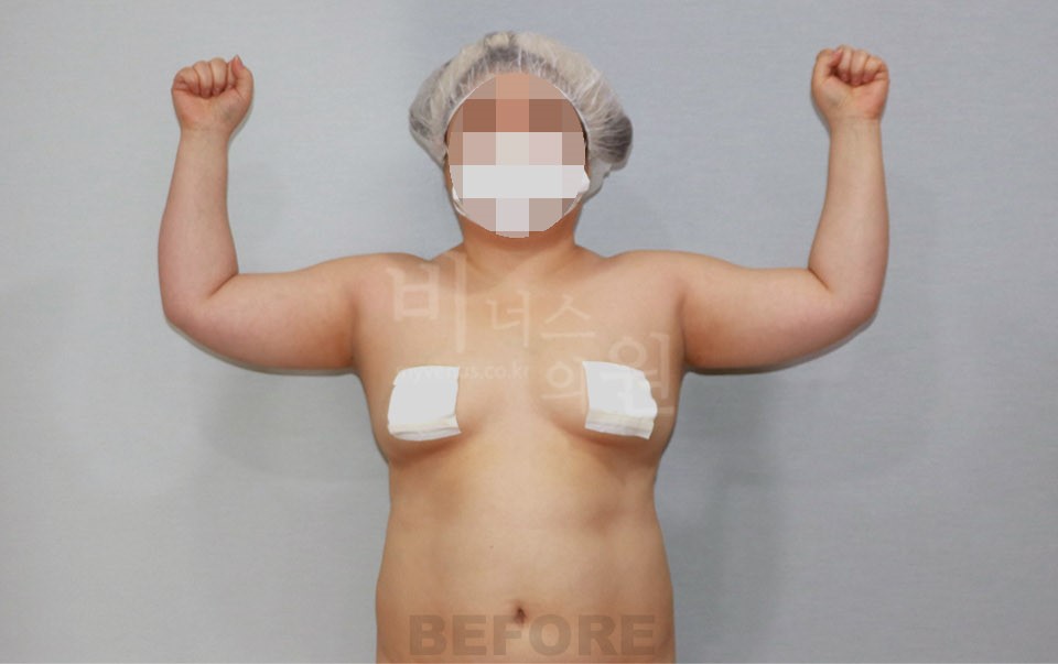 팔뚝 지방흡입 수술 전 정면, 양팔을 위로 올린 자세
