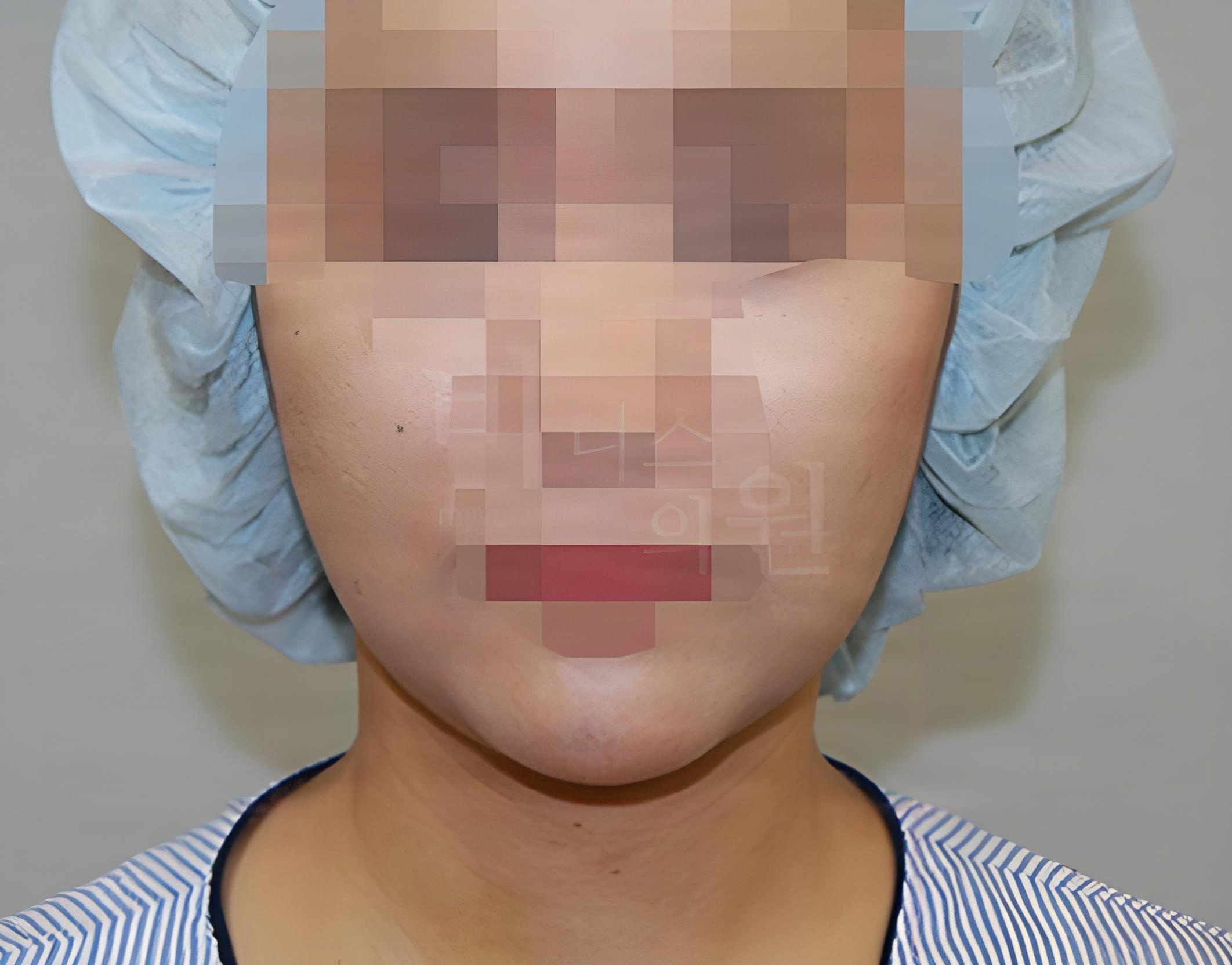 턱·볼·목 지방흡입 수술 후 정면 사진 - 하안면 폭과 턱선 확인