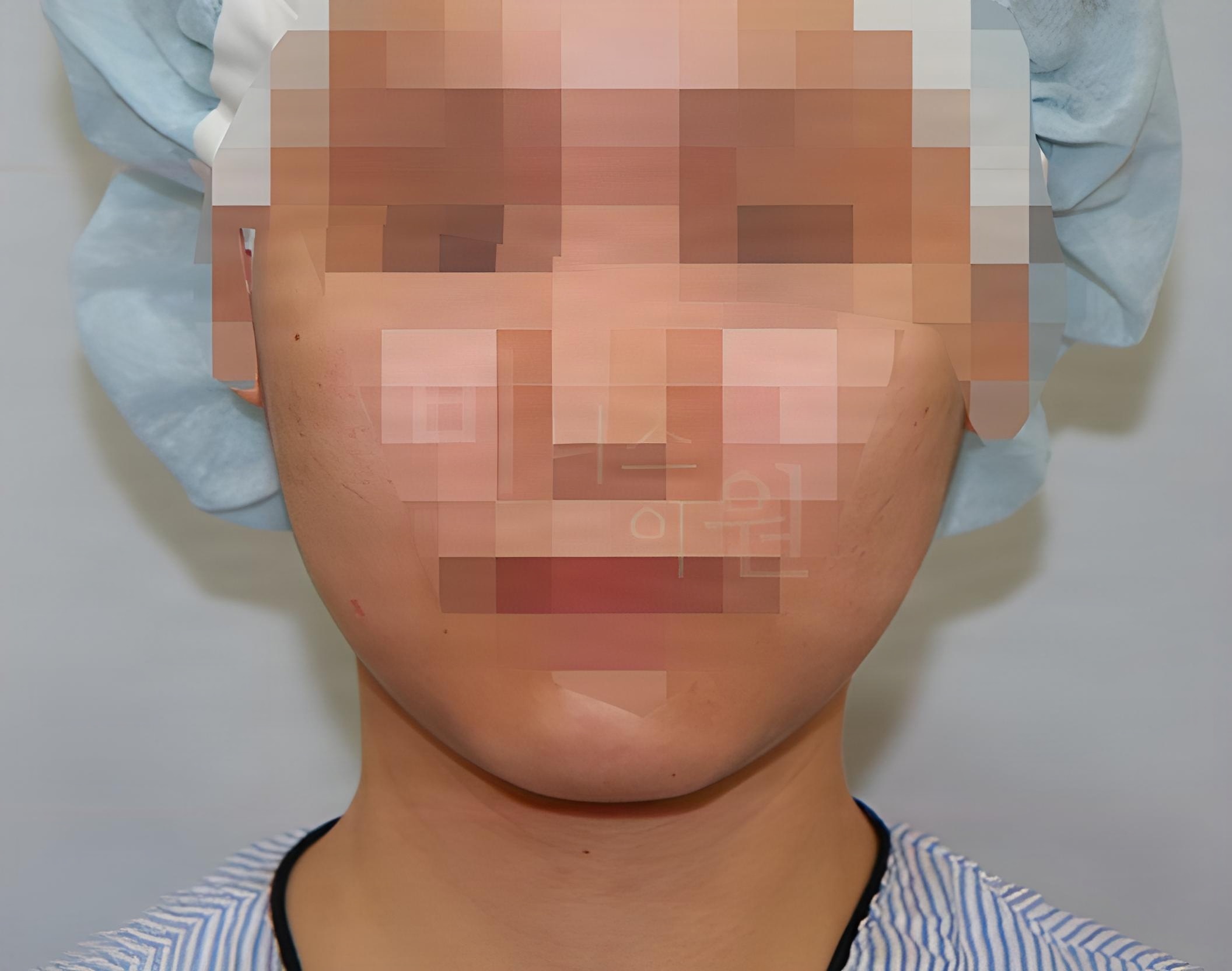 턱·볼·목 지방흡입 수술 전 정면 사진 - 하안면 폭과 턱선 확인