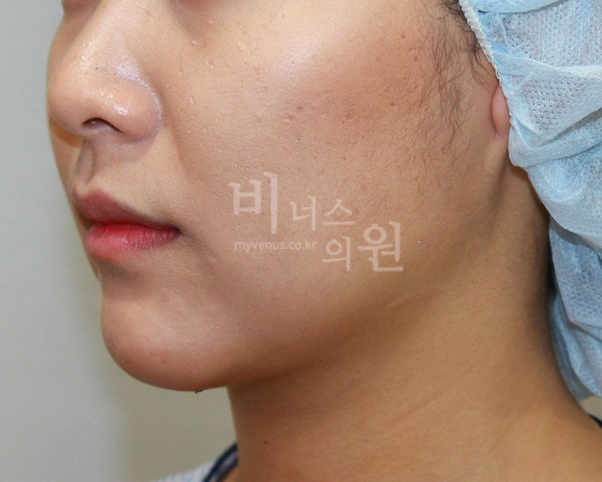 턱·볼·목 지방흡입 수술 후 사진 - 볼에서 턱선으로 이어지는 윤곽 확인