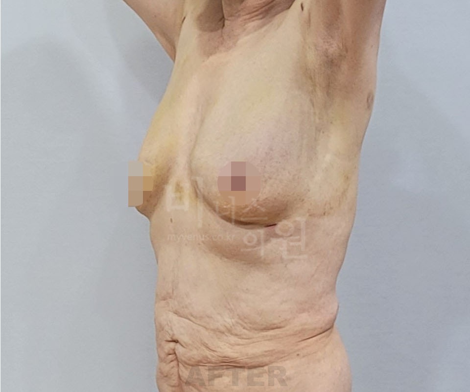 유방하수 가슴 지방흡입 수술 후 45도 사진, 유방 아래쪽의 늘어진 정도가 줄어든 모습