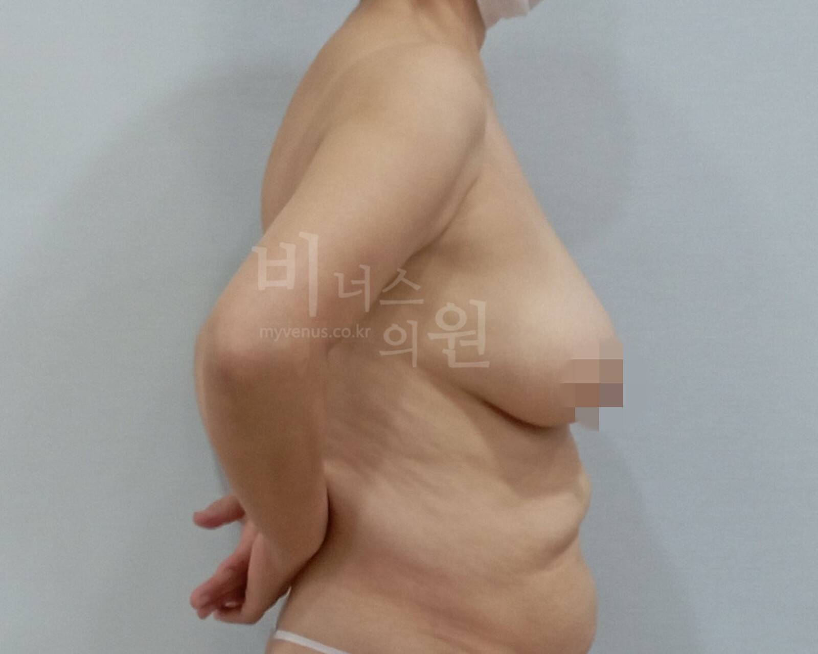 유방하수 지방흡입 수술 전 측면 사진, 팔을 뒤로 둔 자세