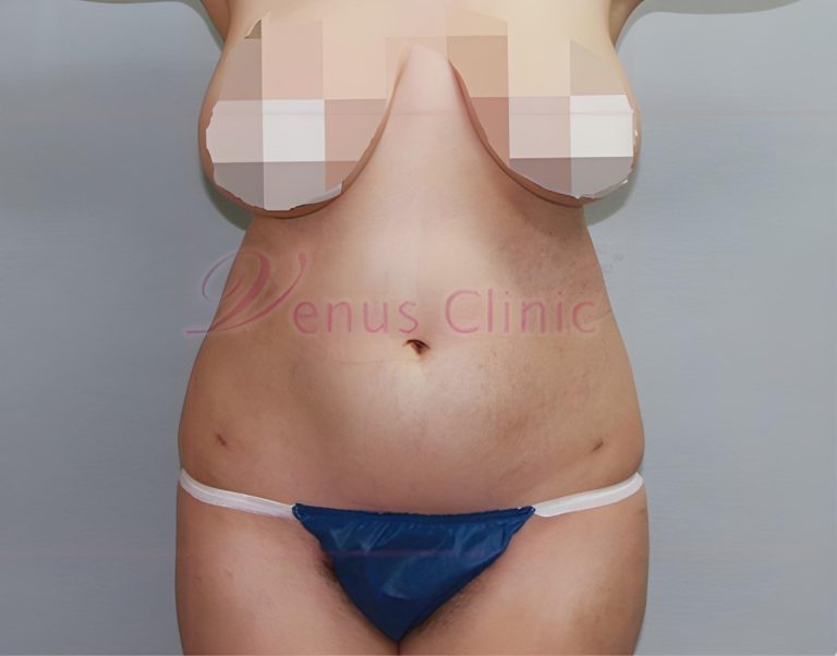 복부지방흡입 후 배가 딱딱하고 울퉁불퉁해요 — 5~7일차 단단함부터 4주, 6개월까지 회복 경과 읽는 법