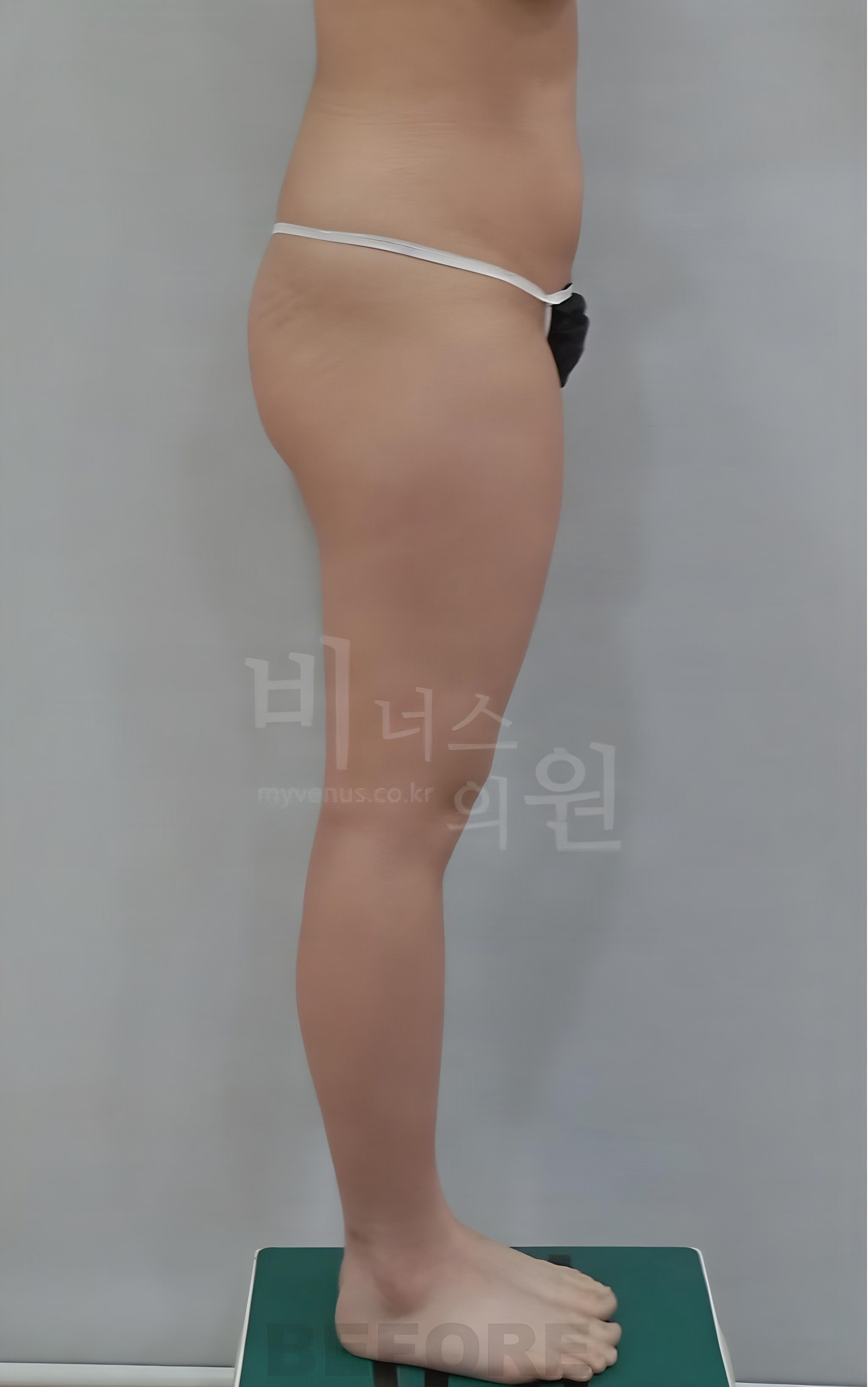 엉덩이축소 지방흡입 우측면 수술 전 사진 - 비너스의원 2025년 촬영 동일인