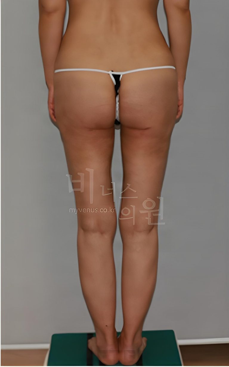 엉덩이축소 지방흡입 회복 중 마음이 흔들리는 다섯 순간 — 붓기 속 사진 한 장으로 결과를 단정하지 않기 위한 체크 노트
