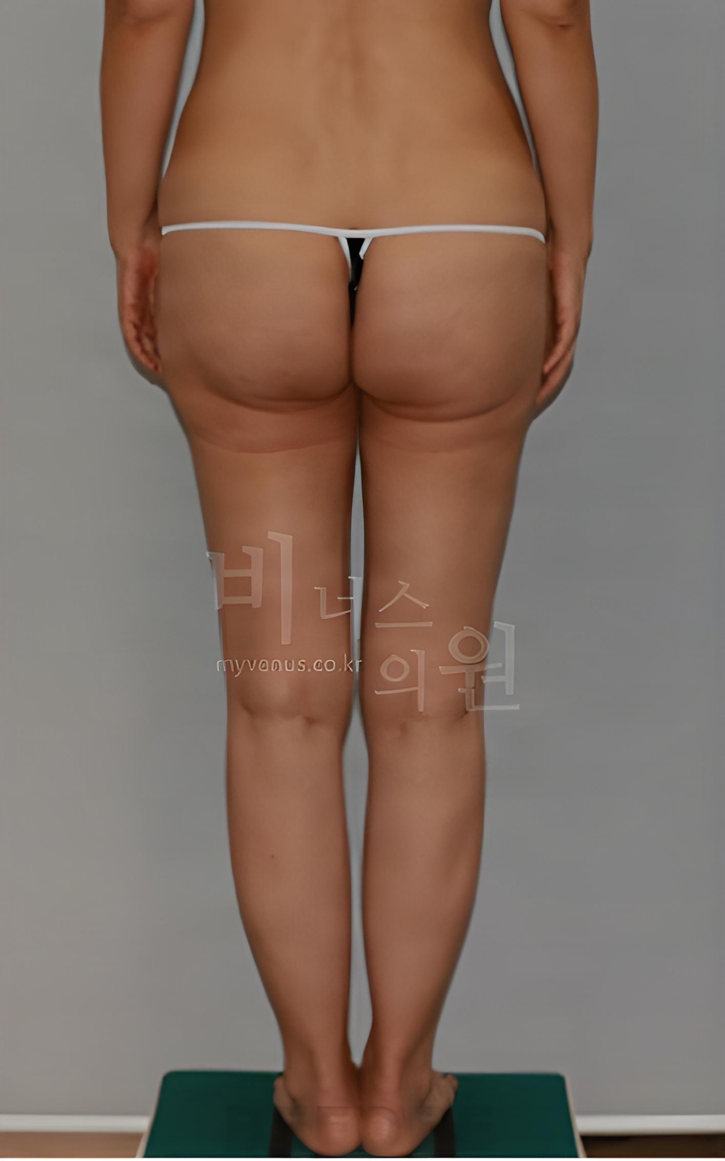 엉덩이축소 지방흡입 후면 수술 전 사진 - 비너스의원 2023년 촬영 동일인