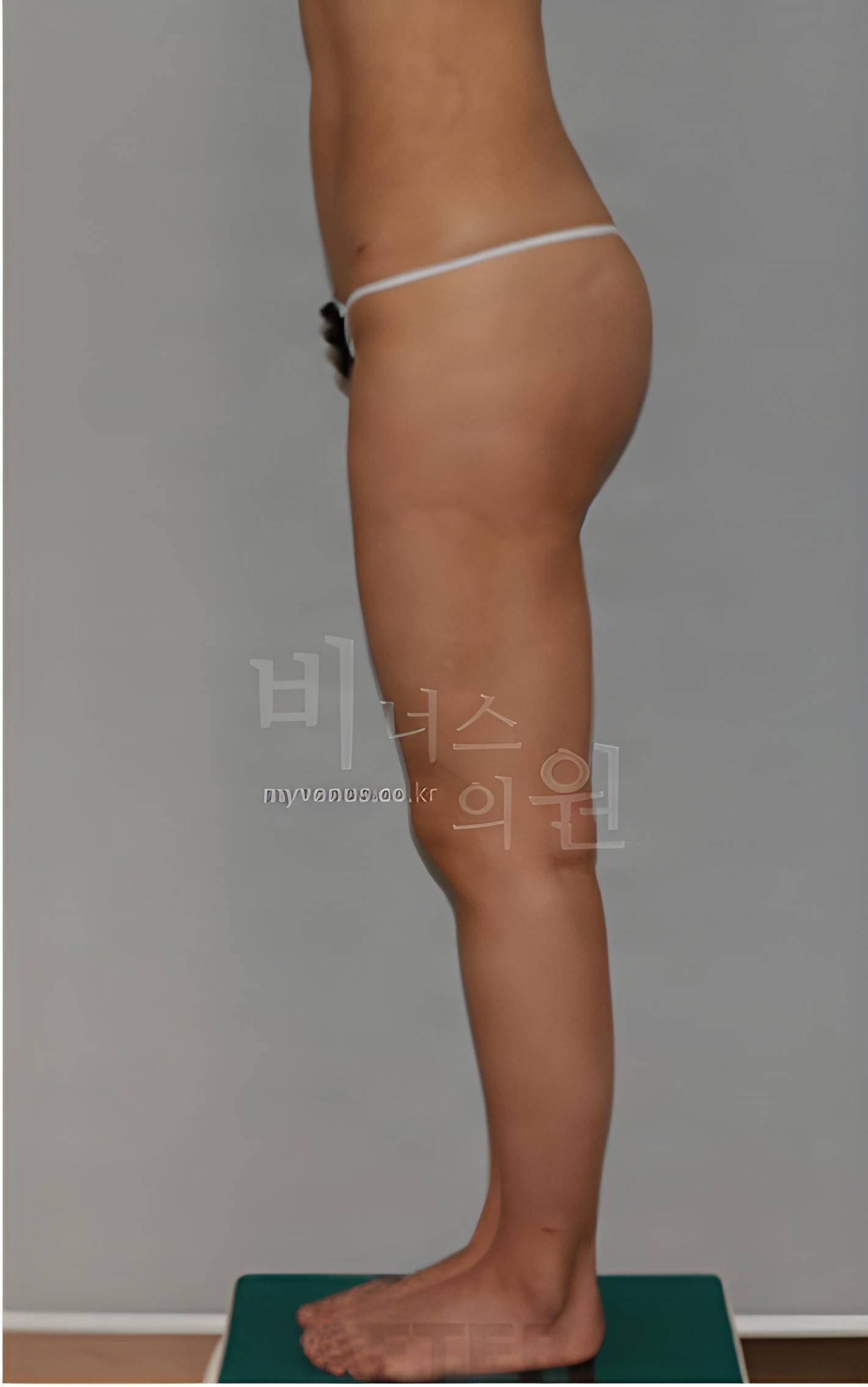 엉덩이축소 지방흡입 좌측면 수술 후 사진 - 비너스의원 2023년 촬영 동일인