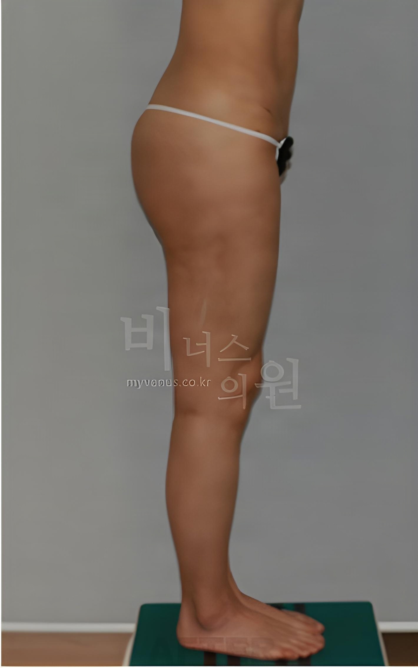 엉덩이축소 지방흡입 우측면 수술 후 사진 - 비너스의원 2023년 촬영 동일인