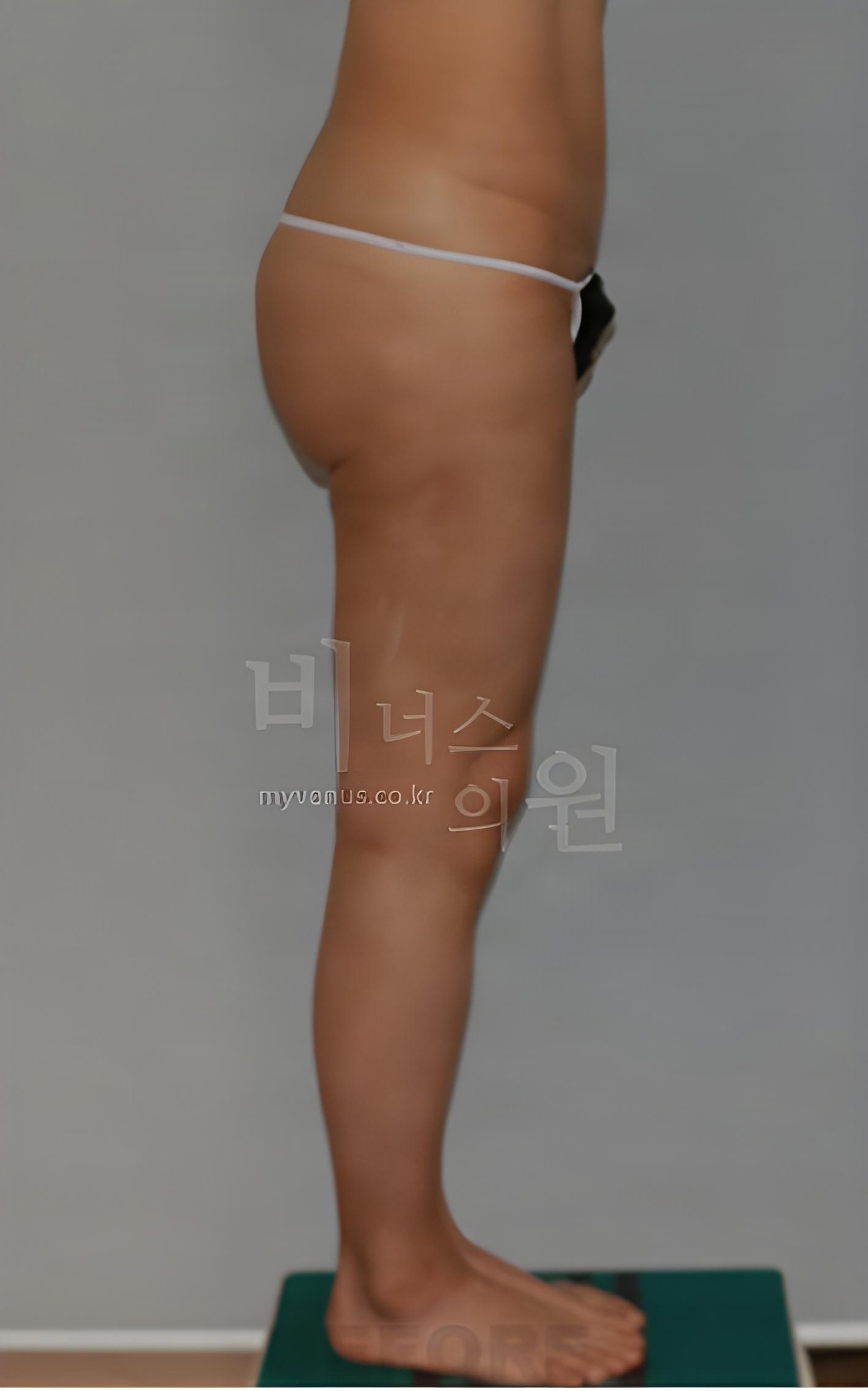 엉덩이축소 지방흡입 우측면 수술 전 사진 - 비너스의원 2023년 촬영 동일인