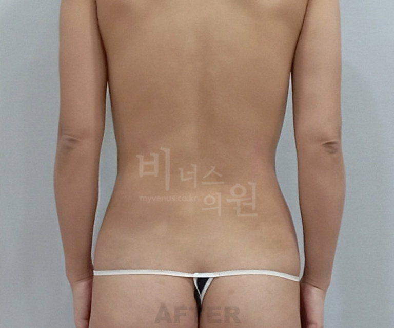 복부 수술 후 후면 사진 (2024년 촬영)