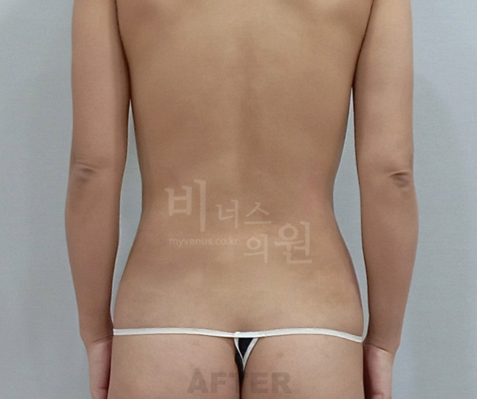 복부 수술 후 후면 사진 (2024년 촬영)