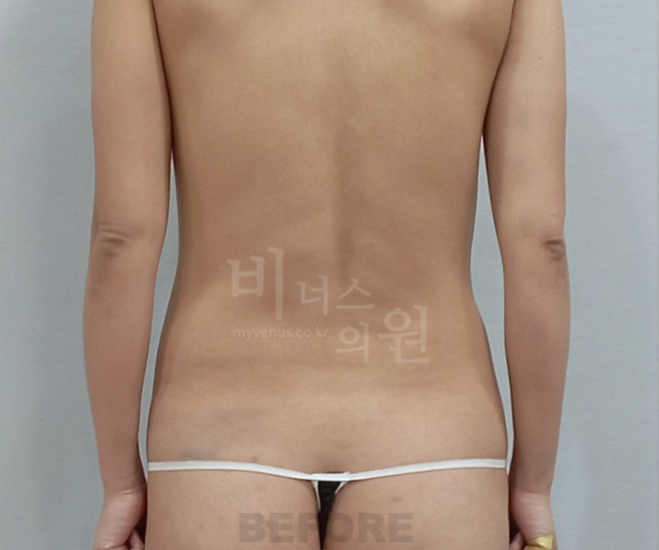 복부 수술 전 후면 사진 (2024년 촬영)
