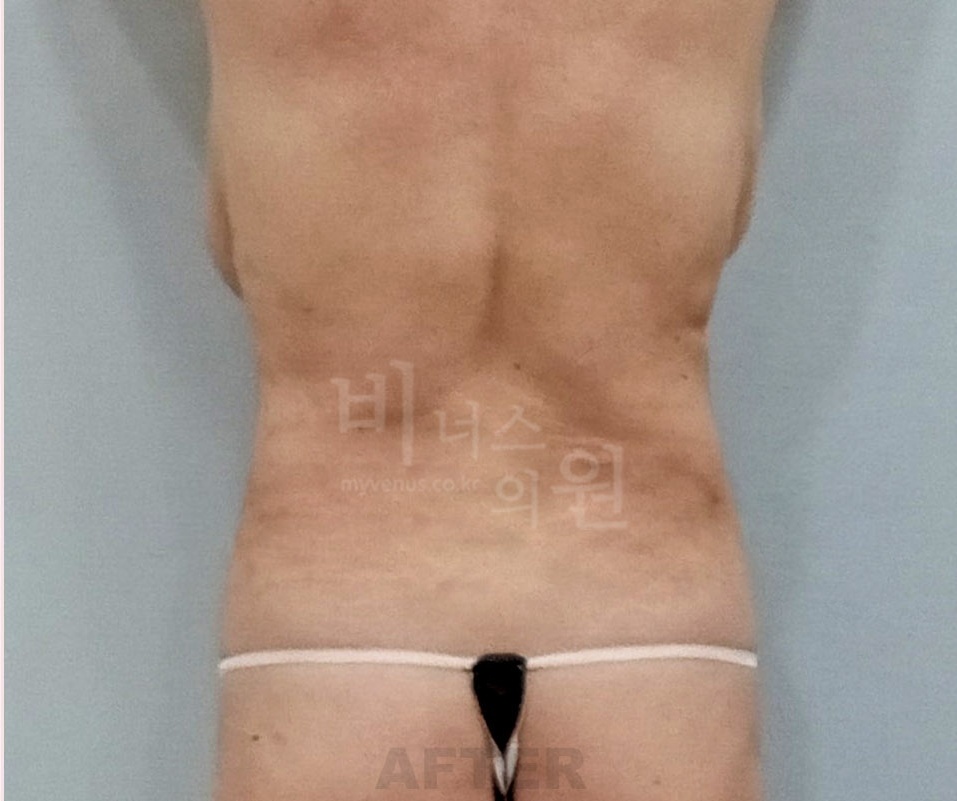 복부 지방흡입 수술 후 후면 사진 - 비너스의원 2023년 촬영 동일인, 복부·옆구리 윤곽