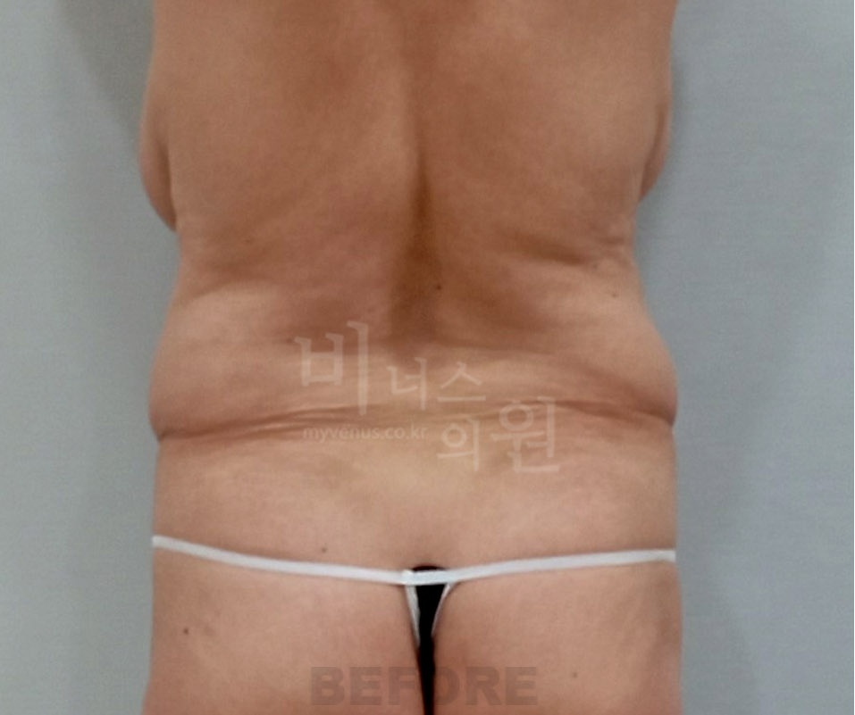 복부 지방흡입 수술 전 후면 사진 - 비너스의원 2023년 촬영 동일인, 복부·옆구리 윤곽