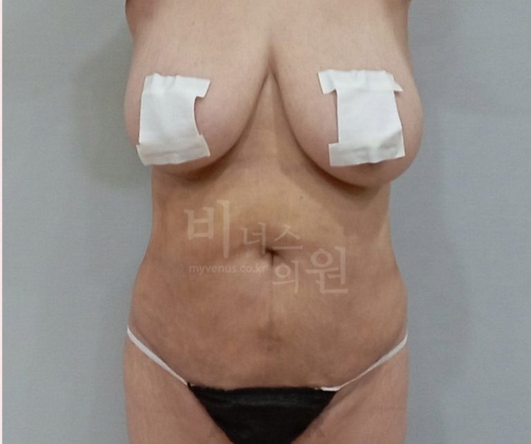 복부지방흡입 뒤 마음이 오르내리는 여섯 순간 — 수술 첫날 밤의 붕대부터 단단해진 배, 석 달째의 낯선 감각, 반년 뒤 체중계 앞까지 자료로 따라가는 회복 마음 노트
